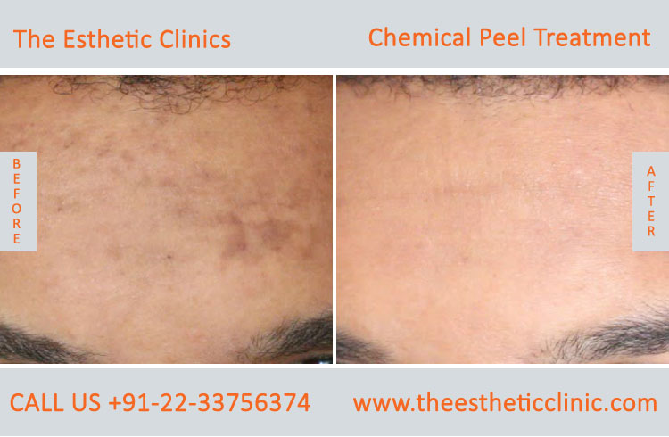 Chemical Peels Treatment before after photos in mumbai india (1)